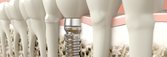 Dental Implants