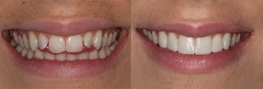 Instant Veneers