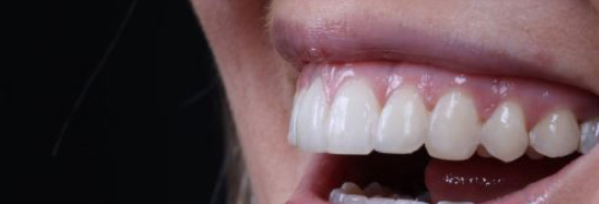 Invisalign Braces