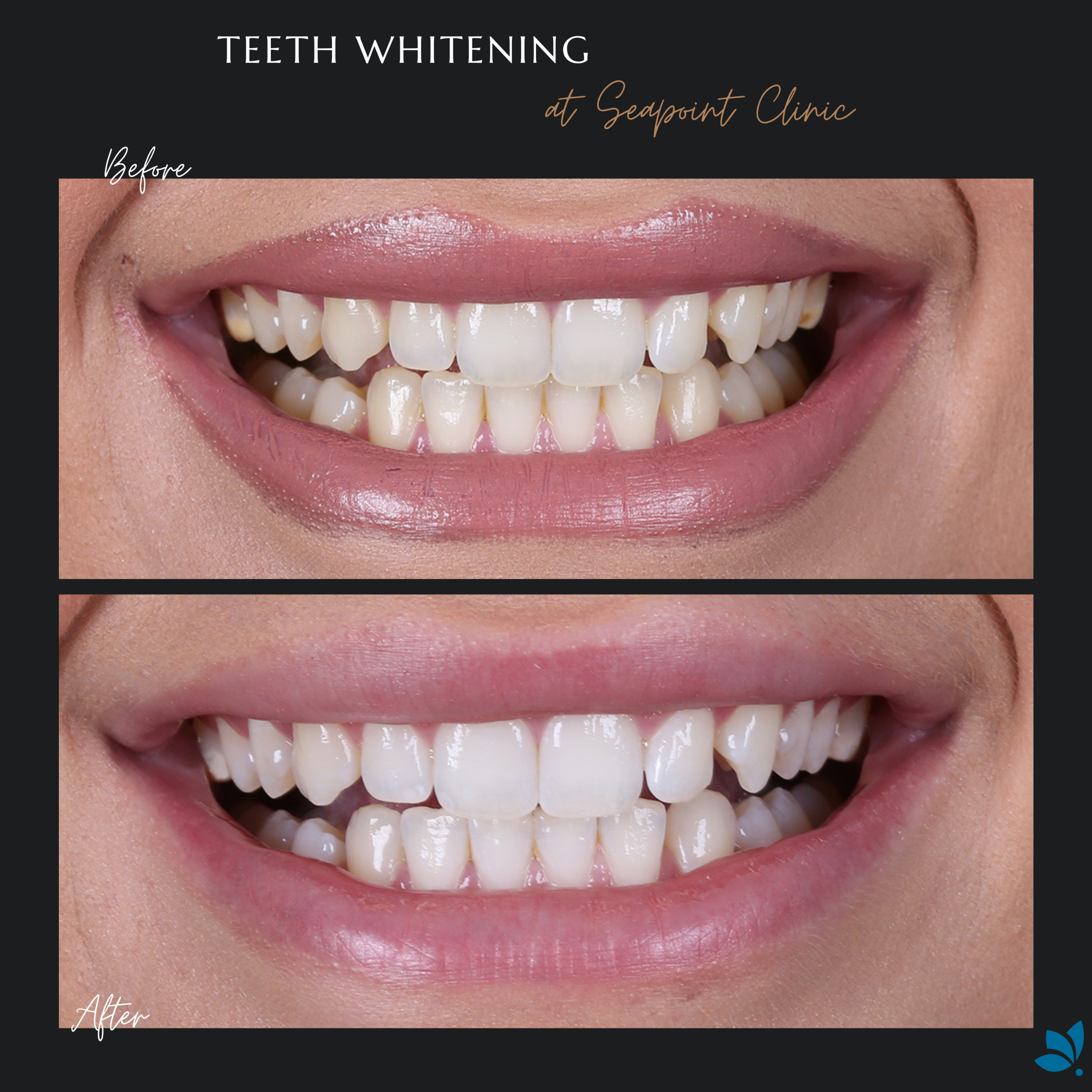 Frequently Asked Questions about Teeth Whitening Seapoint Clinic | Dental Clinic