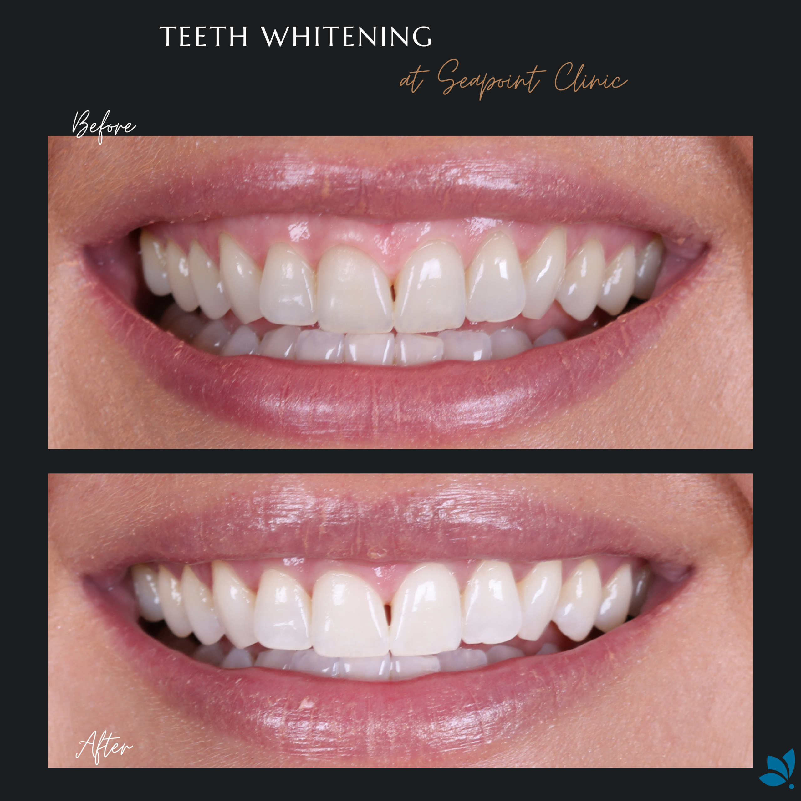 Frequently Asked Questions about Teeth Whitening Seapoint Clinic | Dental Clinic