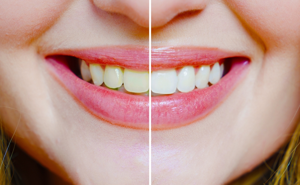 Blog Seapoint Clinic | Dental Clinic