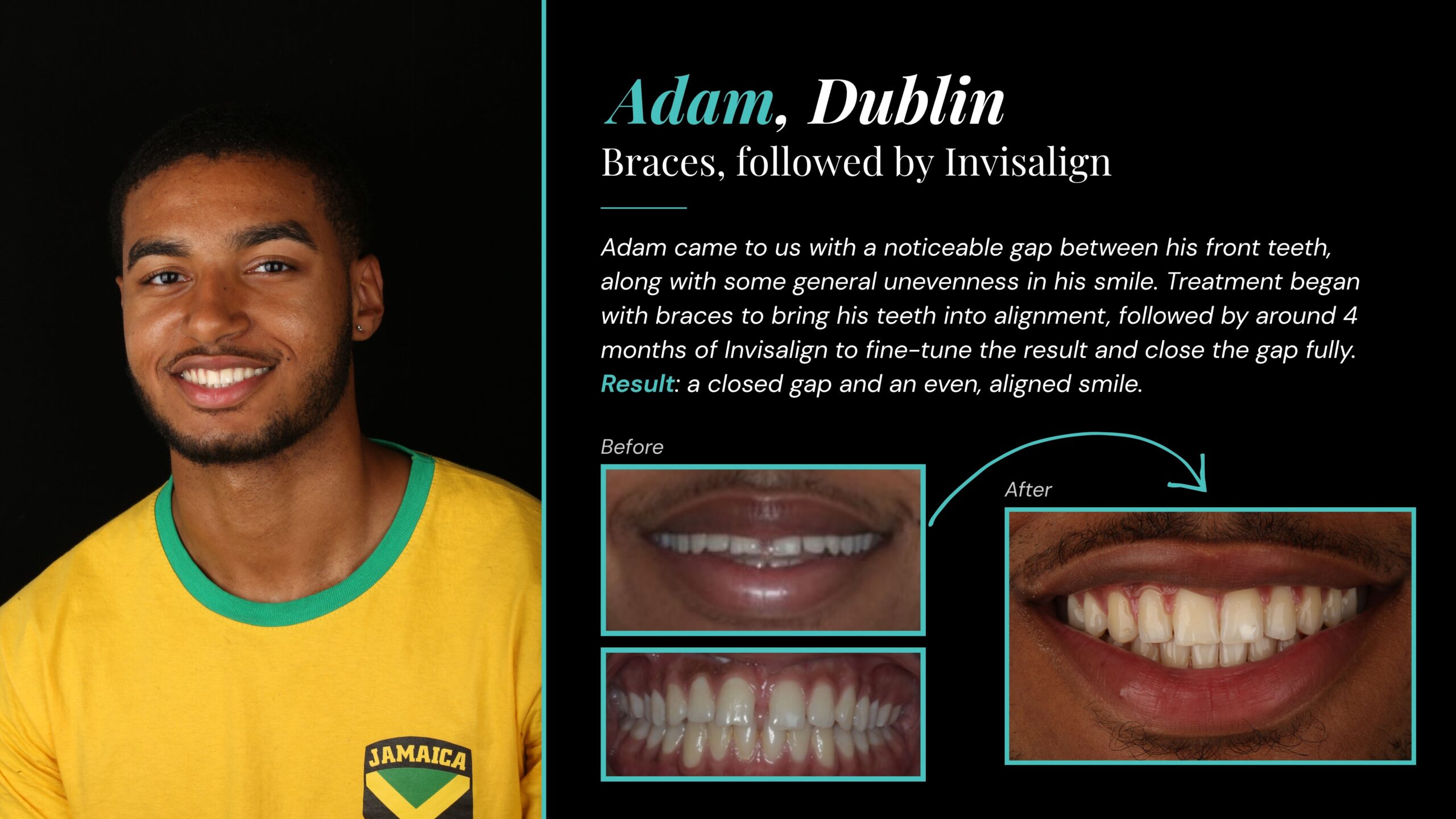 Adam, Dublin — before and after gap closure with braces followed by Invisalign