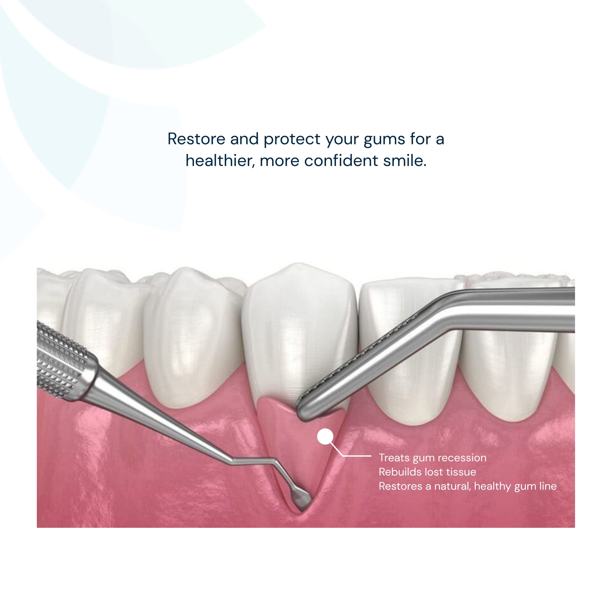 Gum Grafting & Soft Tissue Surgery Seapoint Clinic | Dental Clinic