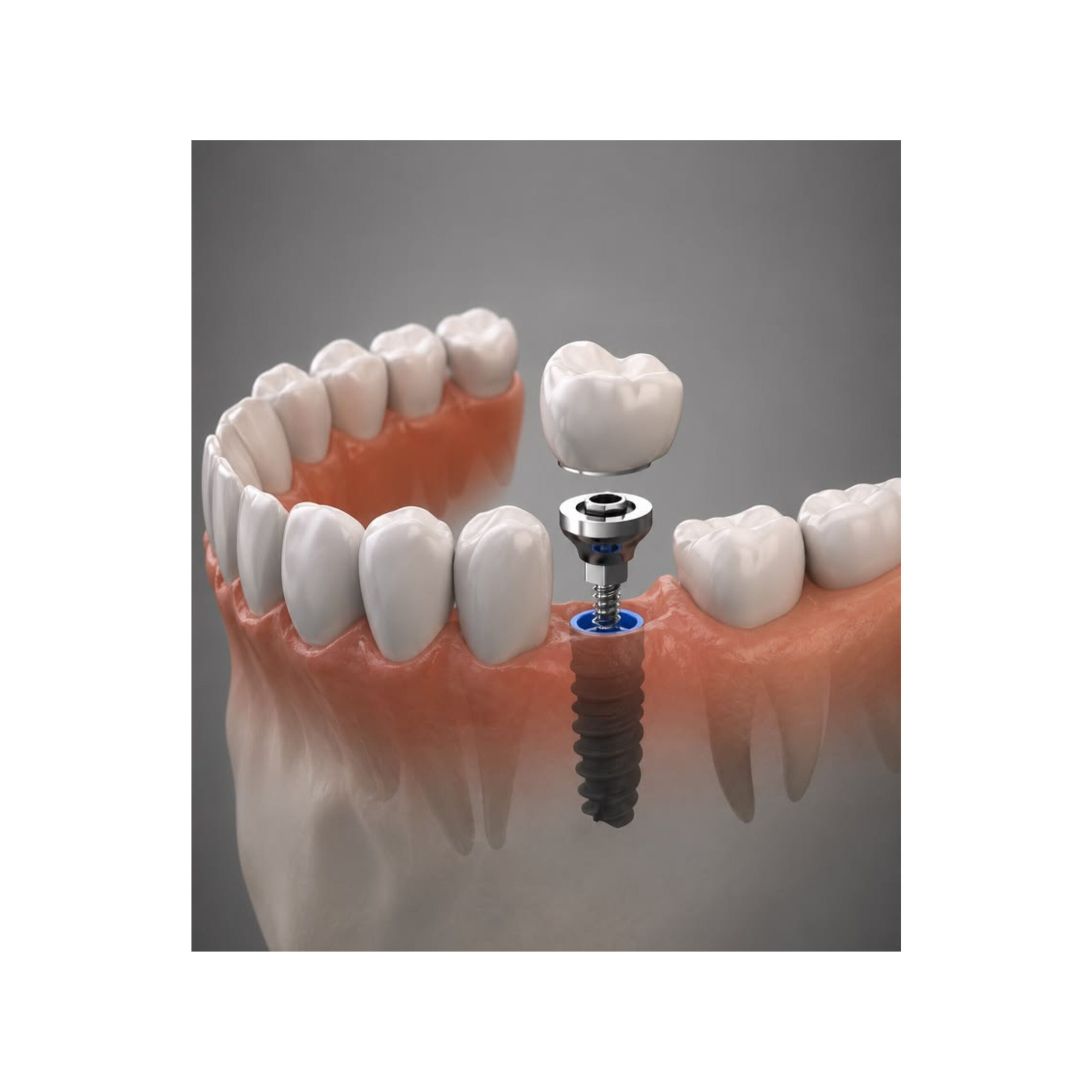 Gum Grafting & Soft Tissue Surgery Seapoint Clinic | Dental Clinic