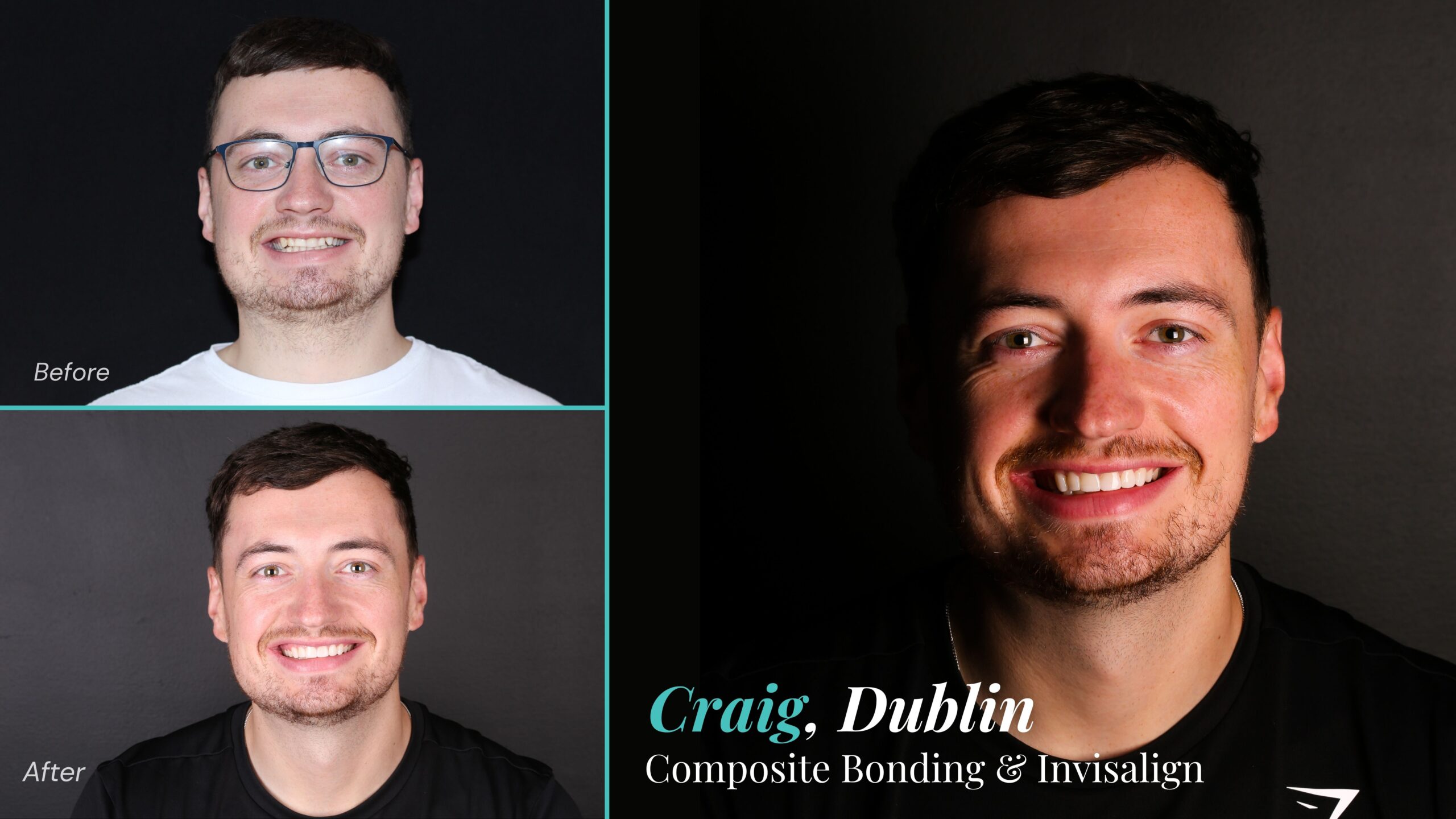Before and after composite bonding and Invisalign: Craig, Dublin