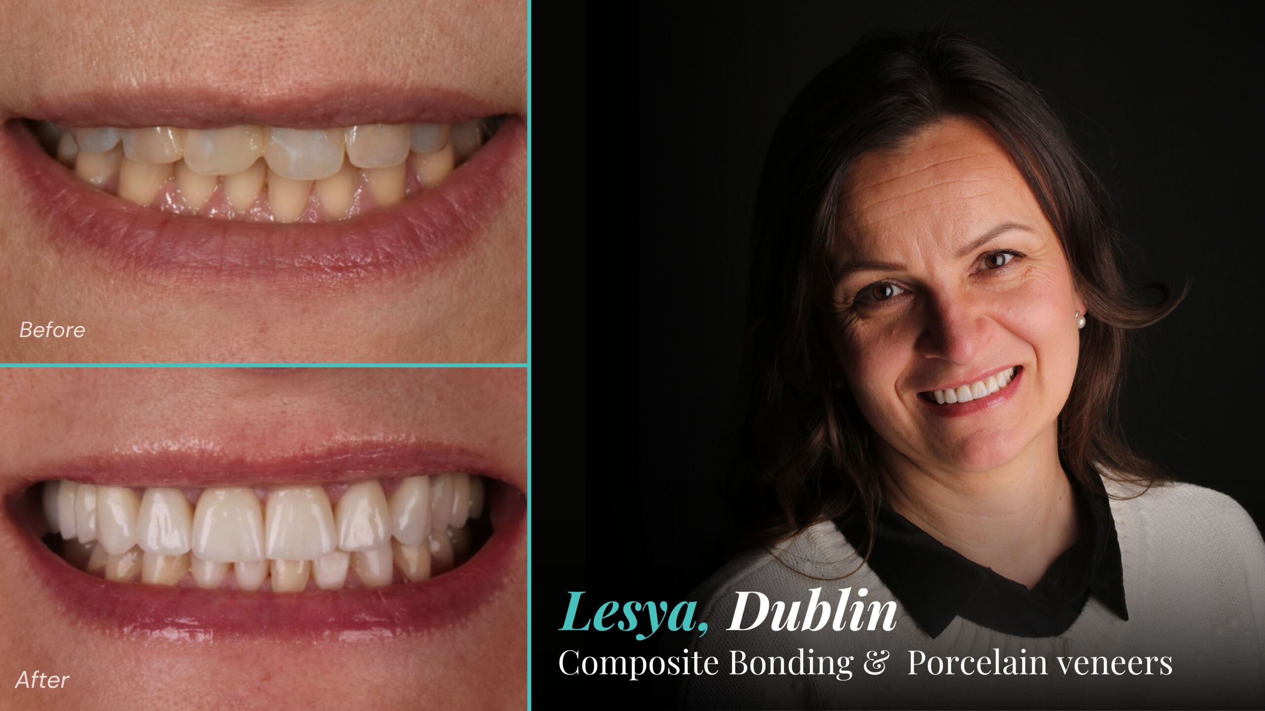 Before and after composite bonding and porcelain veneers: Lesya, Dublin