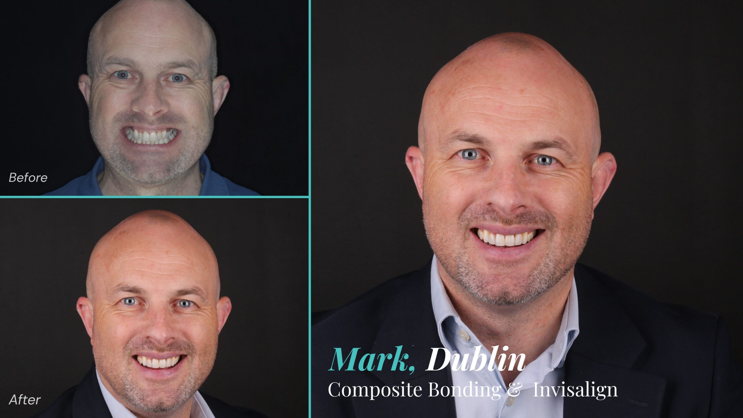 Before and after composite bonding and Invisalign: Mark, Dublin