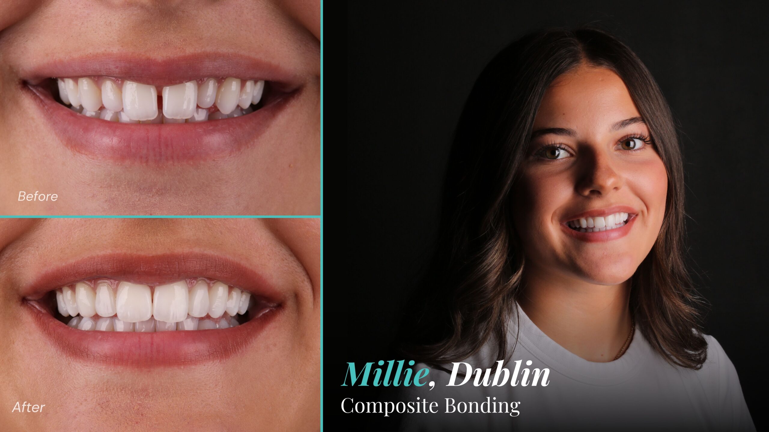 Before and after composite bonding to close a gap between the front teeth: Millie, Dublin