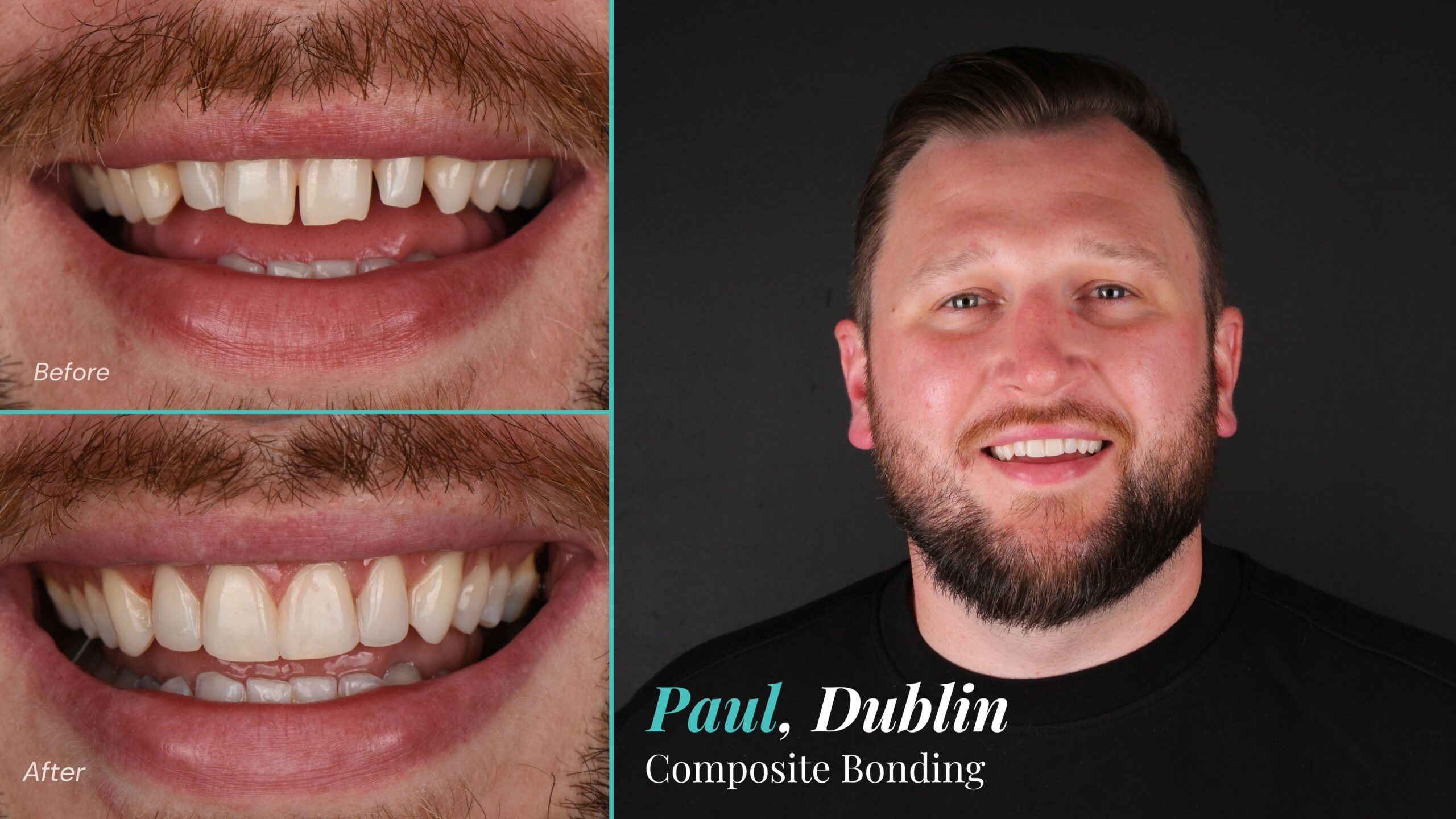 Before and after composite bonding: Paul, Dublin