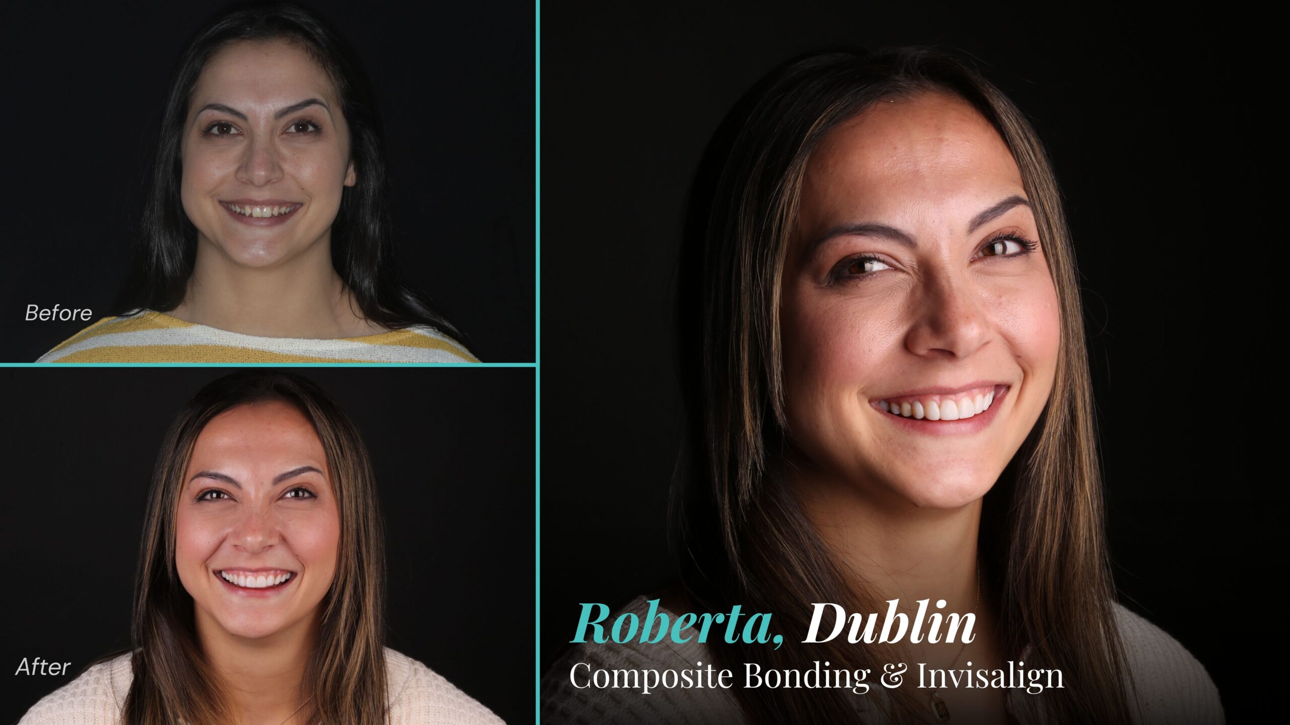 Before and after composite bonding and Invisalign: Roberta, Dublin
